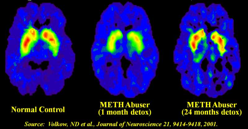 meth recovery brain scans